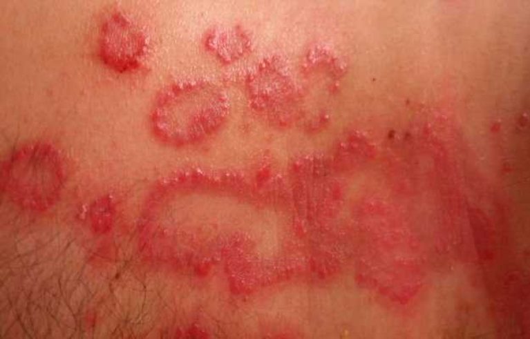What is Contact Dermatitis Effects and How to Treat It!