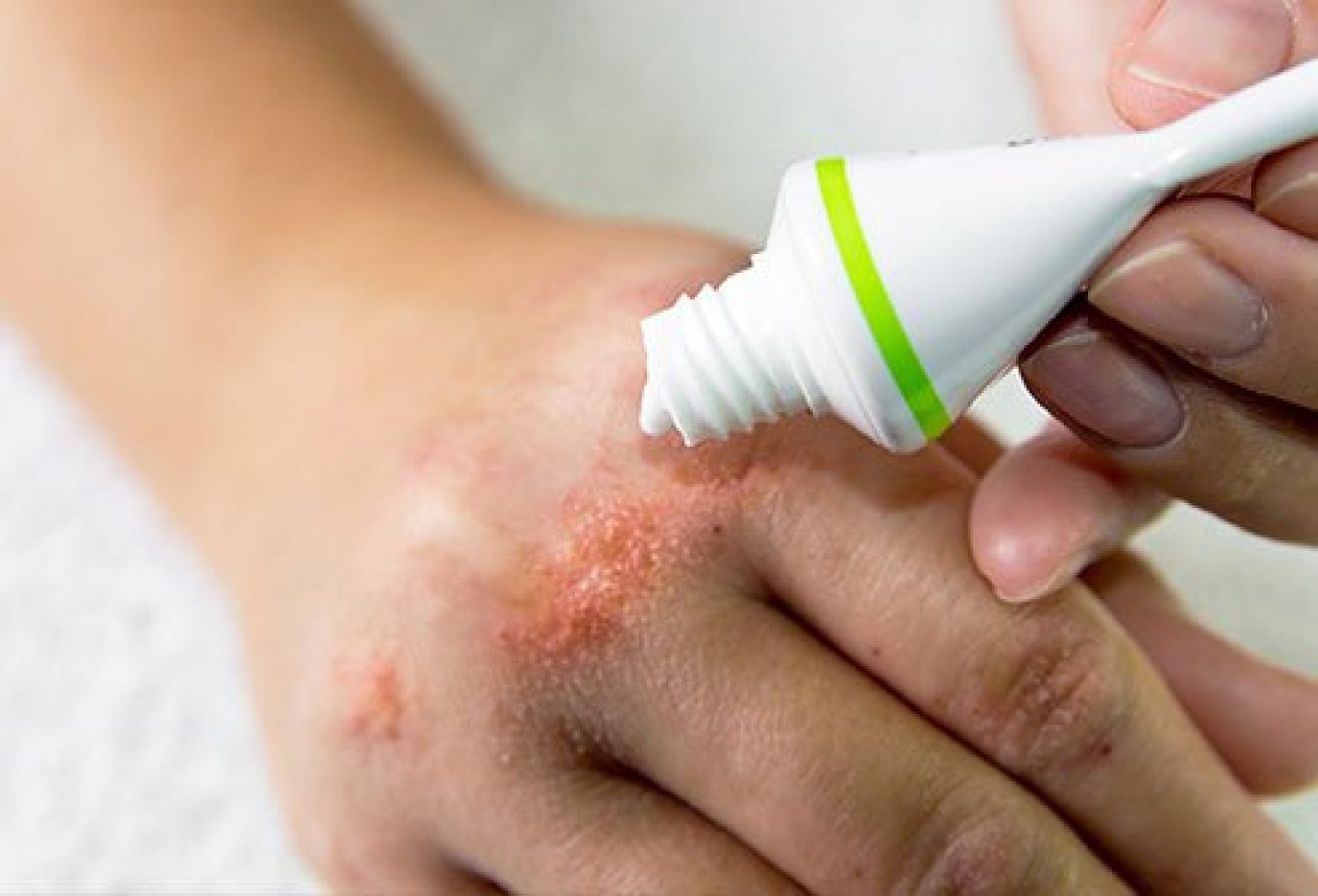 What Is Contact Dermatitis Effects And How To Treat It   Eczema 2 1536x1044 