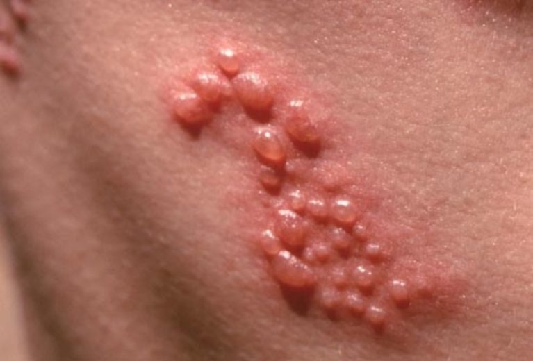 Herpes Zoster or Shingles: Symptoms and Treatment!