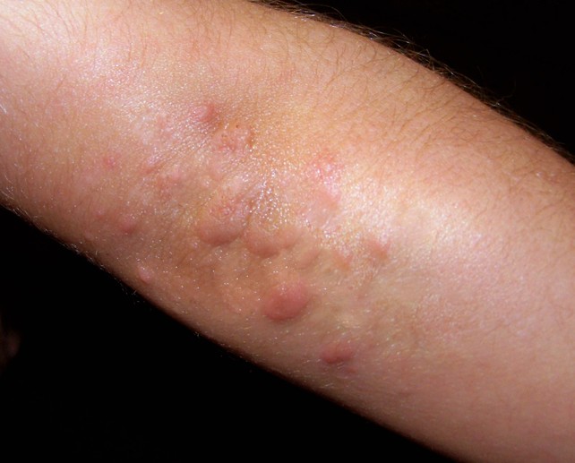 rash-on-elbows