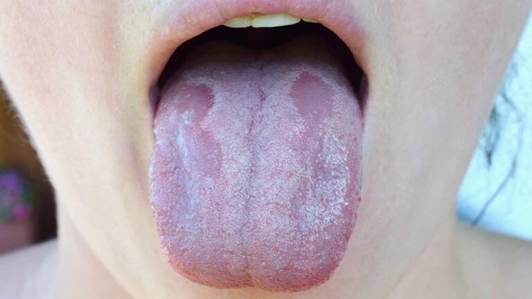 7 Common Signs That May Indicate Vitamin B12 Deficiency!