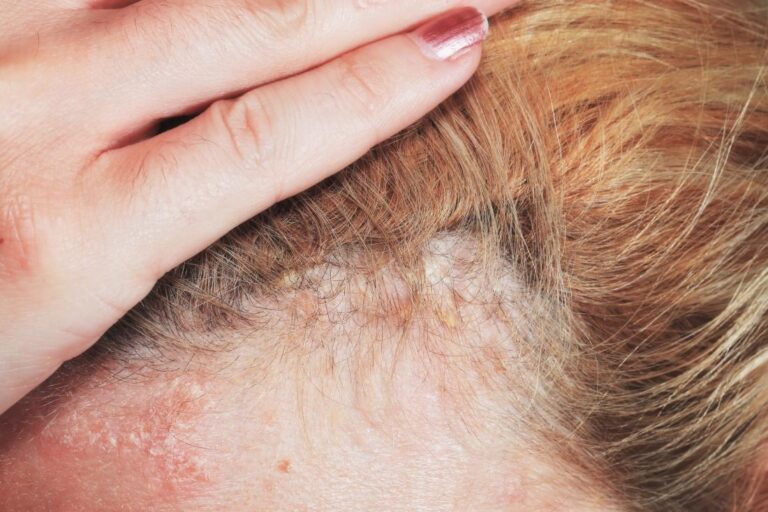 8 Proven and Natural Remedies to Treat Psoriasis!