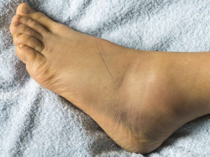 Does Liver Damage Cause Swollen Feet